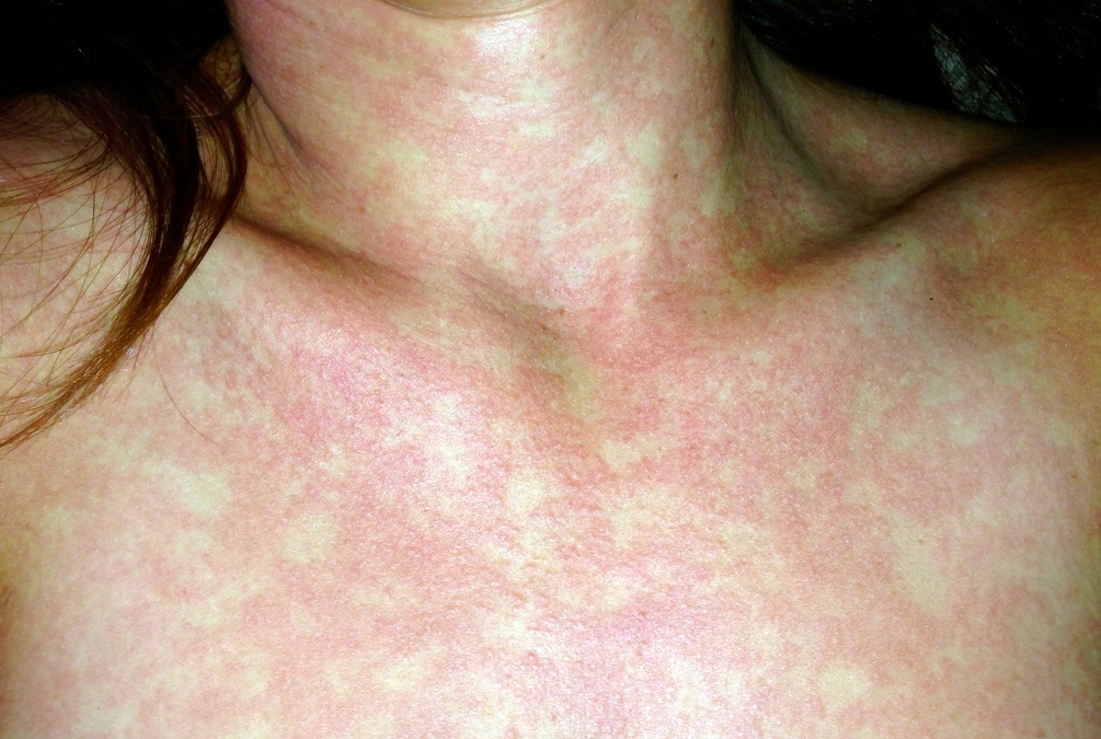 Dengue Fever Rash Features